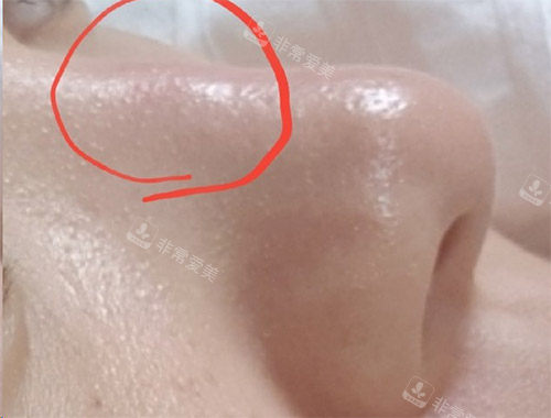 隆鼻炎症透光图片