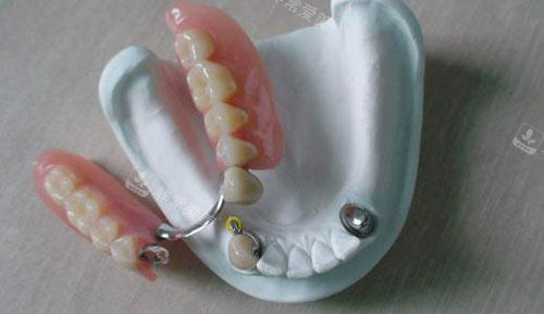 活动假牙半口展示