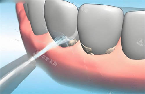 洗牙动画展示图片