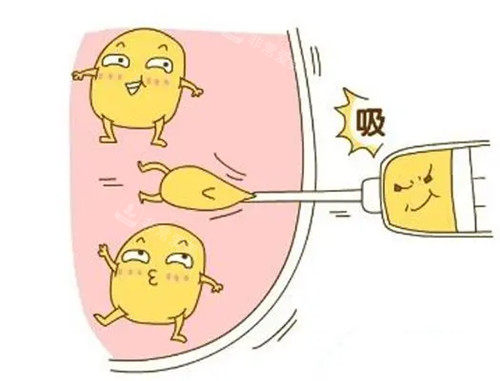 吸脂卡通示意图 吸脂卡通示意图