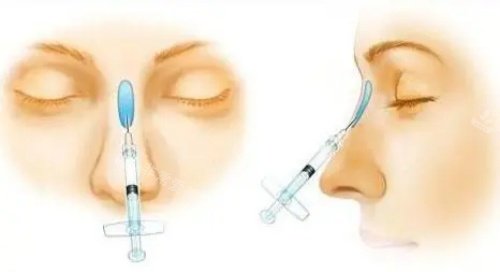 瑞娅玻尿酸注射示意图