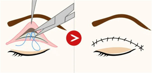 埋線雙眼皮過(guò)程