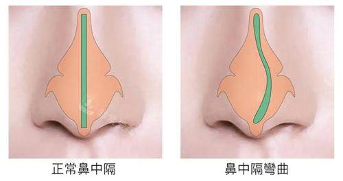 鼻中隔偏曲和正常鼻子的对比