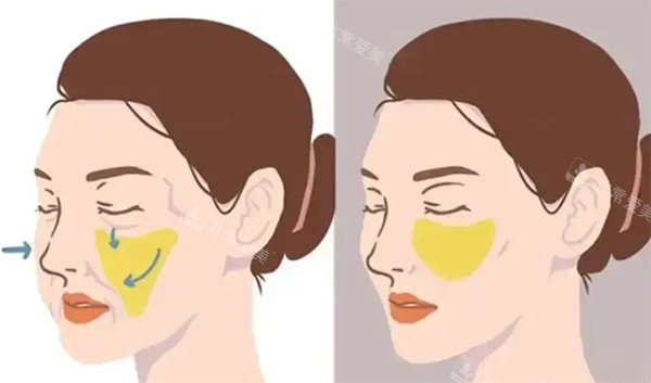 饅化臉脂肪移位照片