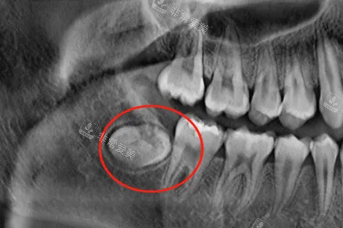 阻生智齿埋伏牙片示意图