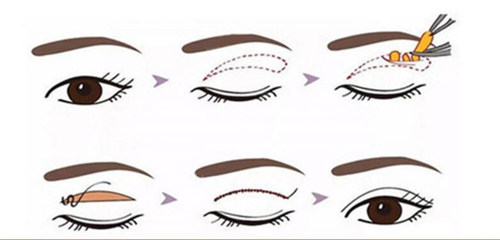 全切雙眼皮過(guò)程示意圖 全切雙眼皮過(guò)程示意圖
