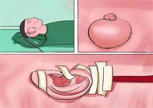 擴張器法耳再造手術(shù)演示圖