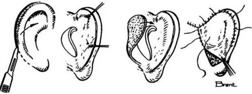 耳再造手術(shù)過程