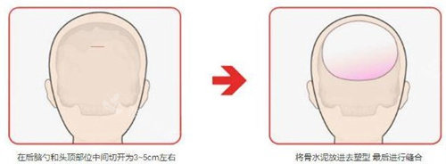 后腦勺整形手術(shù)圖