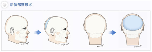 太惊喜了！我做韩国骨水泥填充后脑勺居然不用剃光头，术后改善快还很自然