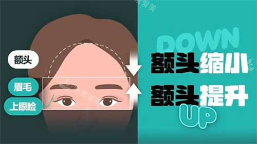 揭秘韩国额头提升！分享我在韩国做的额头提升是怎么提升的？成效如何？