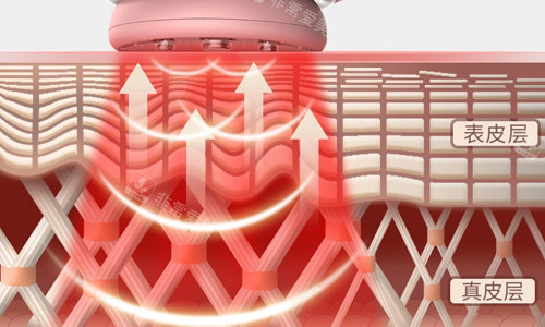 光子嫩膚激光作用展示