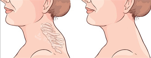 富貴包吸脂前后對比