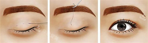 正在進行的雙眼皮手術(shù) 正在進行的雙眼皮手術(shù)