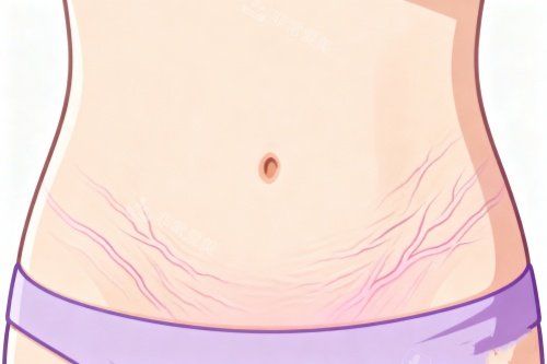 妊娠紋卡通展示圖