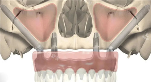 穿颧穿翼种植正面图