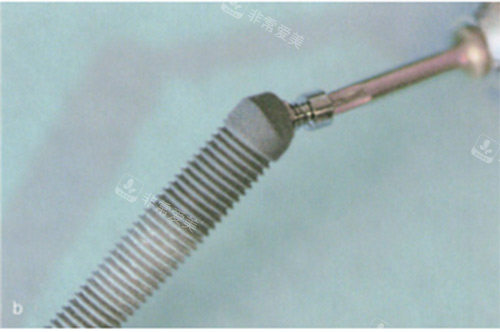 穿颧穿翼种植材料