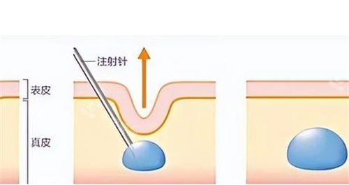 玻尿酸注射皮肤前后对比