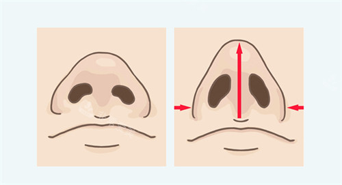 鼻翼缩后鼻子挺拔