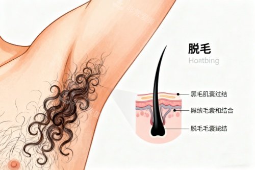 腋下脱毛卡通图