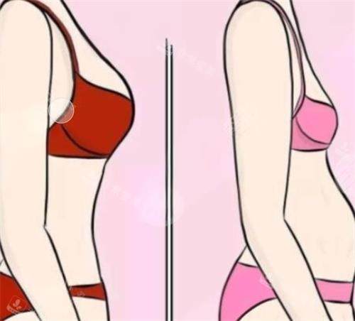 韩国隆胸修复效果好吗？假体+自体脂肪复合术，触感柔软宛若天生！