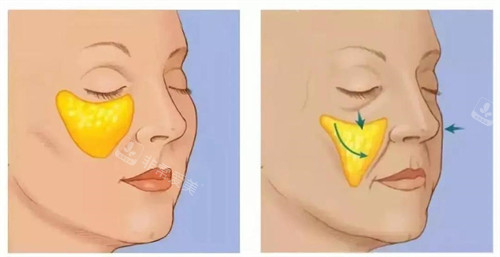 郑州卢建伟医生苹果肌复位做的怎么样？多点U型固定+网兜状技术适配轻中重度下垂，价格3800元起