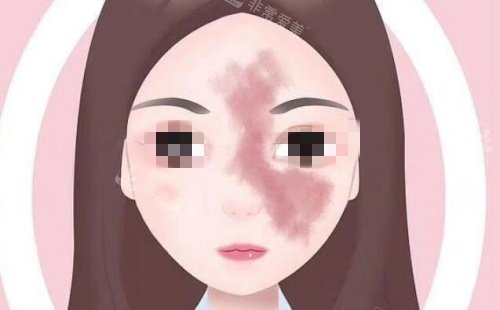 面部胎記示意圖