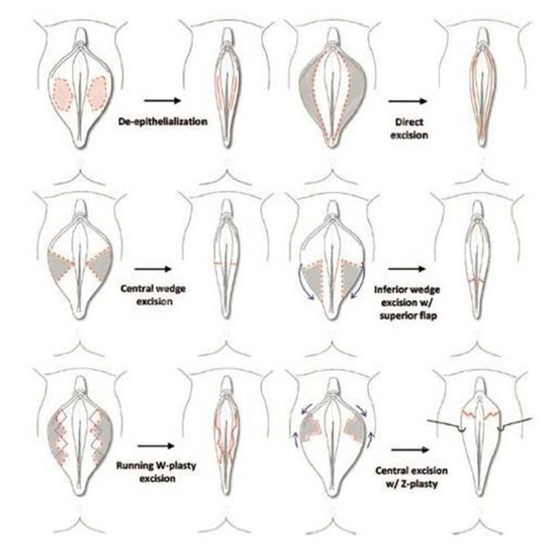 私密陰唇手術(shù)方法照片