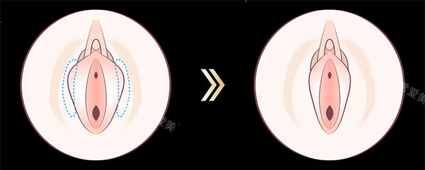 陰唇一長一短改善圖片