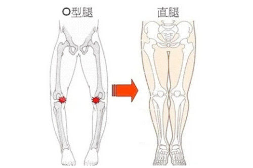 腿型矯正圖對比
