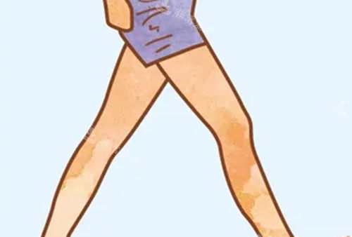 去韩国做直腿术真实感受分享，术前沟通充分/术后有专人护理指导/改善安心腿型改善结果超满意！