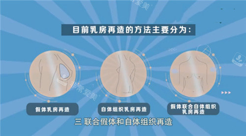 乳房再造手术方式