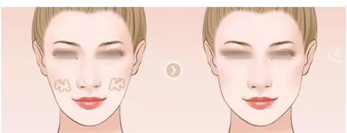 面部填充对比图