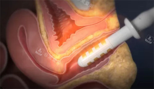 半岛FemeTite操作方式