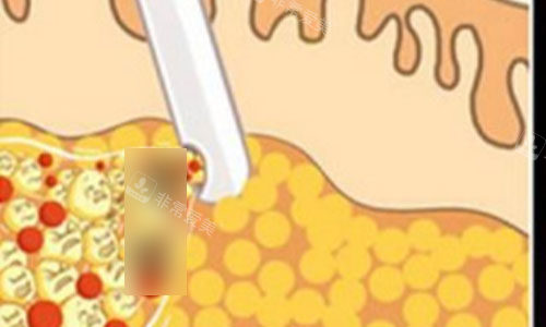 吸脂动画示意图