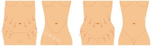 腹壁成形可改善的腰腹状态