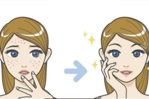 祛痘卡通对比展示图 祛痘卡通对比展示图
