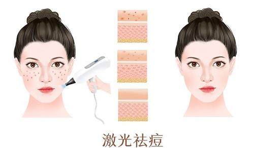 激光祛痘前后的对比 激光祛痘前后的对比