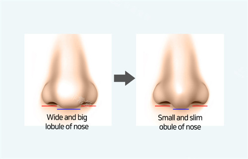 韩国做鼻翼缩小靠谱医院整理，除了优雅人整形，梦想整形和朱诺整形也是不错的医院！