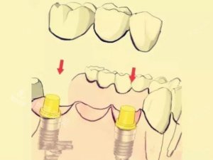 钛合金烤瓷牙漫画示意图