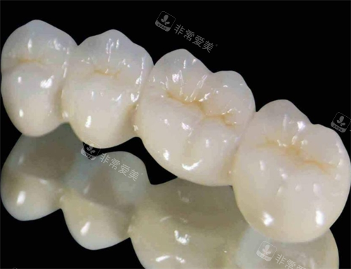 钯金烤瓷牙模型