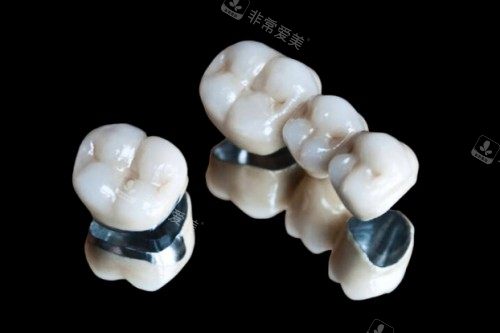 烤瓷牙冠模型图