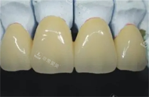 钯金烤瓷牙展示