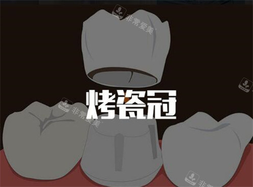 烤瓷牙改善图照片