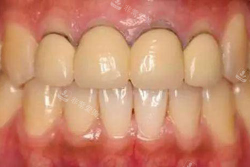 烤瓷冠牙龈黑线