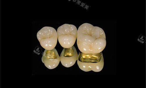 各类金属烤瓷牙展示图