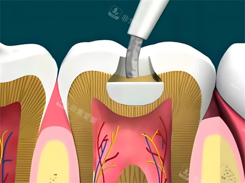 树脂补牙动画展示