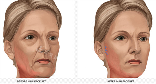 改善皮膚皺紋的面部提升 改善皮膚皺紋的面部提升