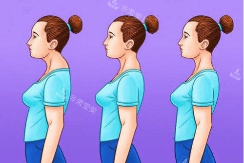 富贵包整形前后对比图