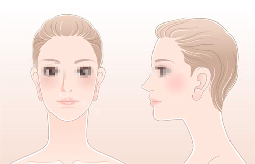 隆鼻手术对比